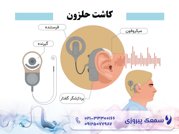 درمان ناشنوایی مادرزادی